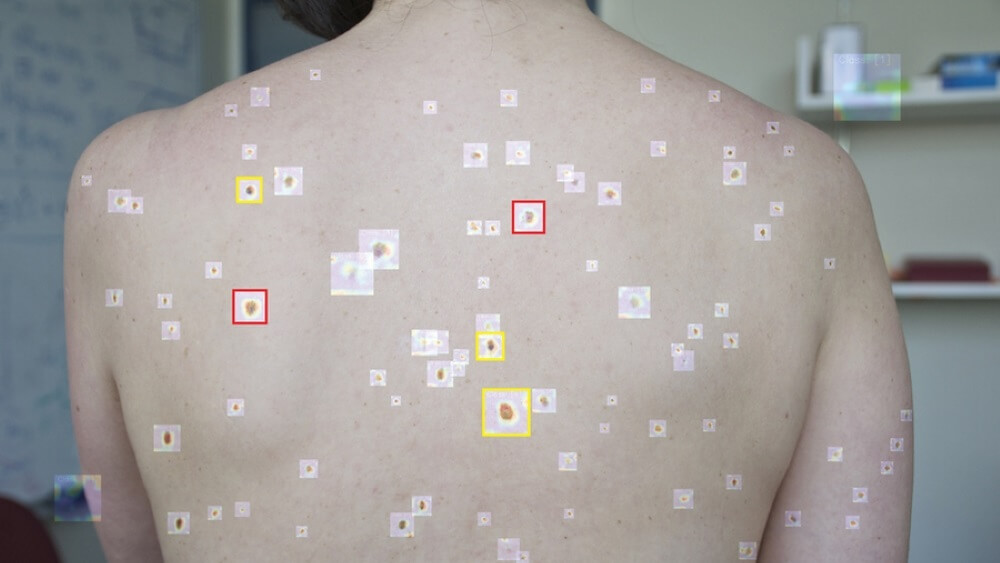 AI Detects Melanoma